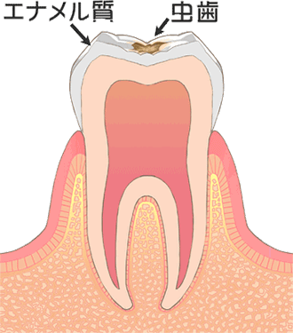 軽度のむし歯のイメージ図