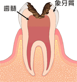 重度のむし歯のイメージ図
