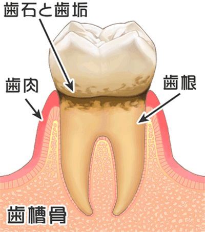 歯周病になっている歯ぐき